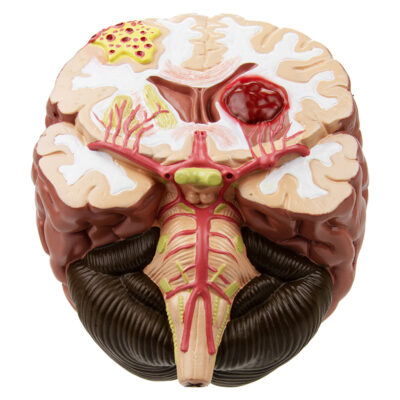 Seção do Cérebro com Patologia CE11