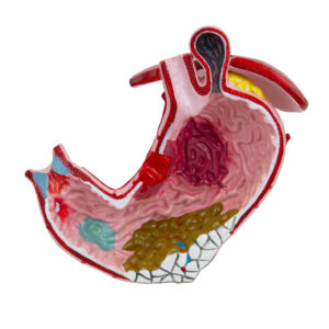 Estômago com Úlceras Gástricas ET17 modelo em tamanho natural  dissecado em um plano medial que descreve as patologias comuns do estômago. 
