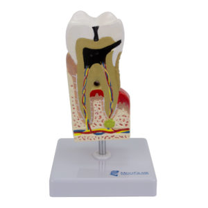 Doença Dental Ampliado 10 Vezes é um modelo de parte de um dente 10 vezes o tamanho natural que mostra as patologias dentárias mais importantes.