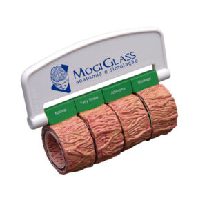 Seção da Artéria com Aterosclerose 4 estágios CO43