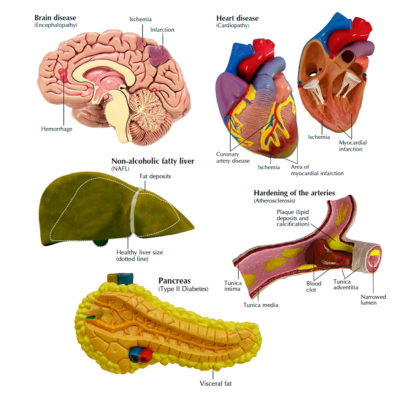 Modelo de Síndrome Metabólica detalhe