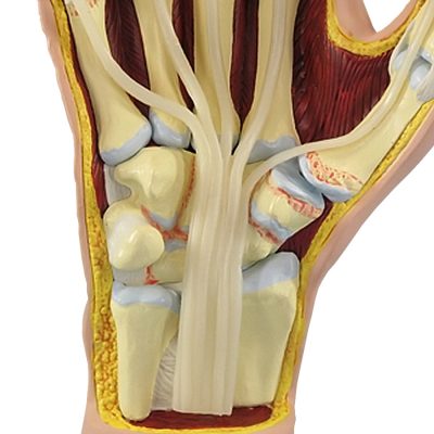 Mão com Artrite Reumatoide