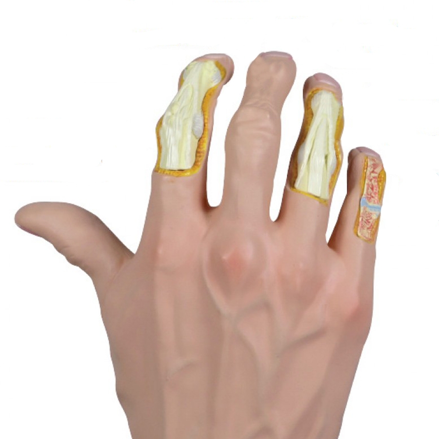 Mão com Osteoartrose