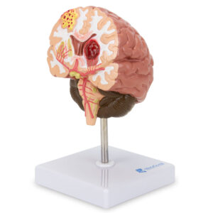 Seção do Cérebro com Patologia