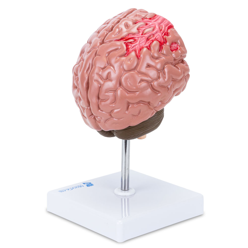Seção do Cérebro com Patologia CE11