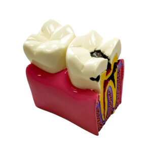 Doença Dental comparativo ampliado 6 vezes DE23