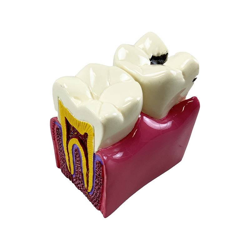 Doença Dental comparativo ampliado 6 vezes DE23