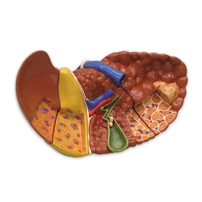 Seção de Luxo do Fígado com patologia FI11