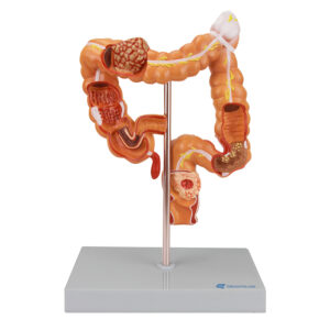 Patologias Intestinais Cólon e Reto SD551 mostra o intestino grosso, o cólon ascendente, transversal e sigmoide, o apêndice e o reto.