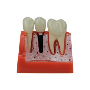 Modelo Implante Dental 8 Partes DE07 