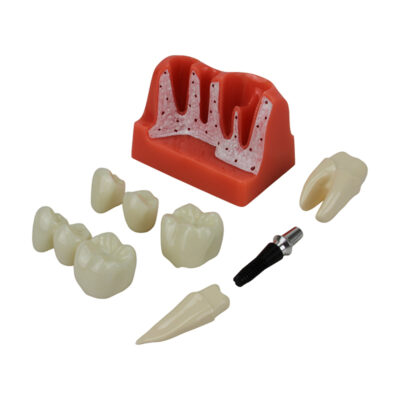 Modelo Implante Dental 8 Partes DE07